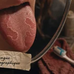 Langue géographique stress : plaques rouges sur la langue en miroir